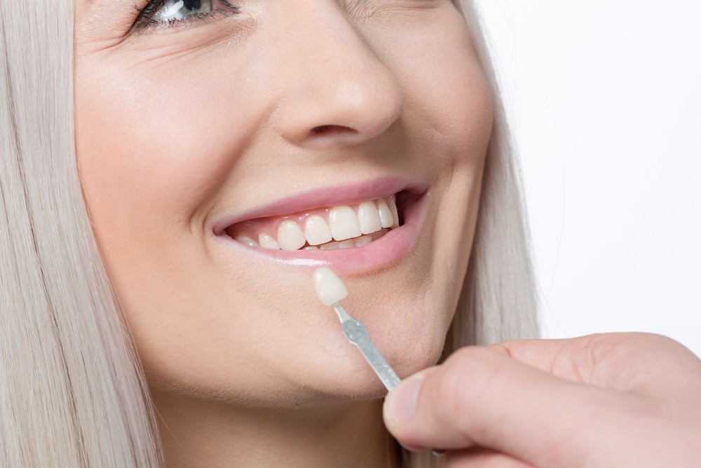 alma ga cosmetic dentist veneers